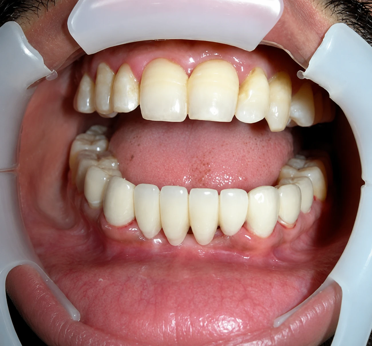 Dental Implant