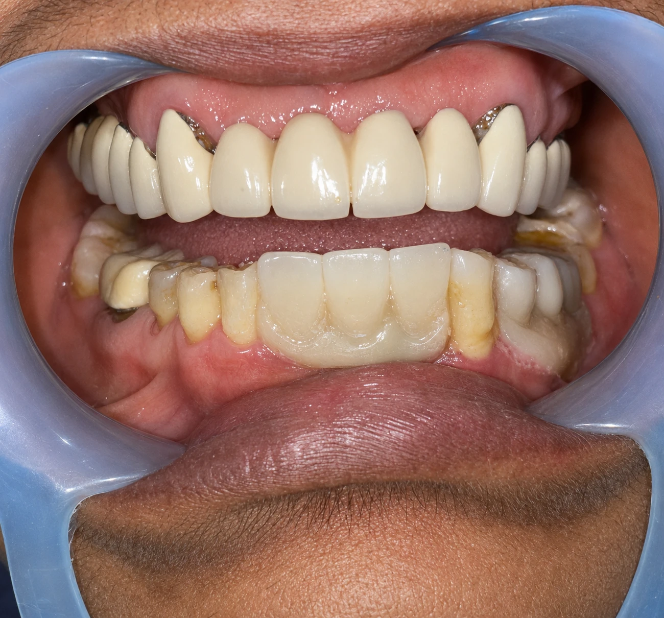Dental Implant
