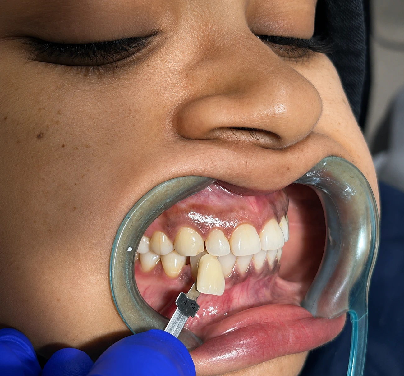 Dental Implant