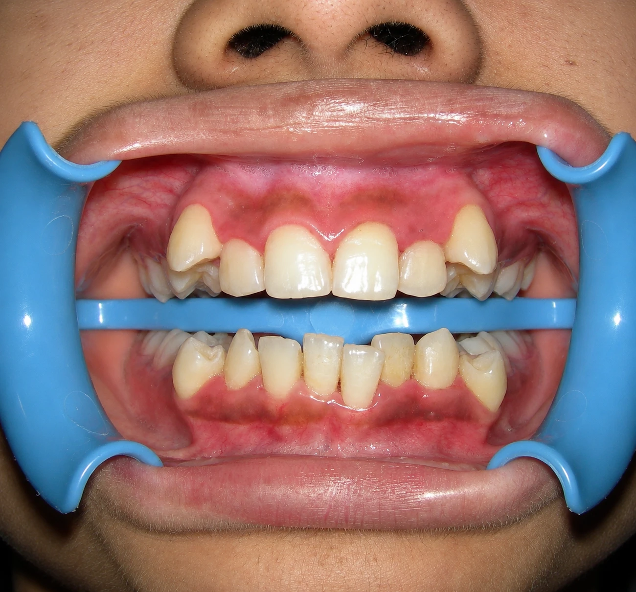Dental Implant