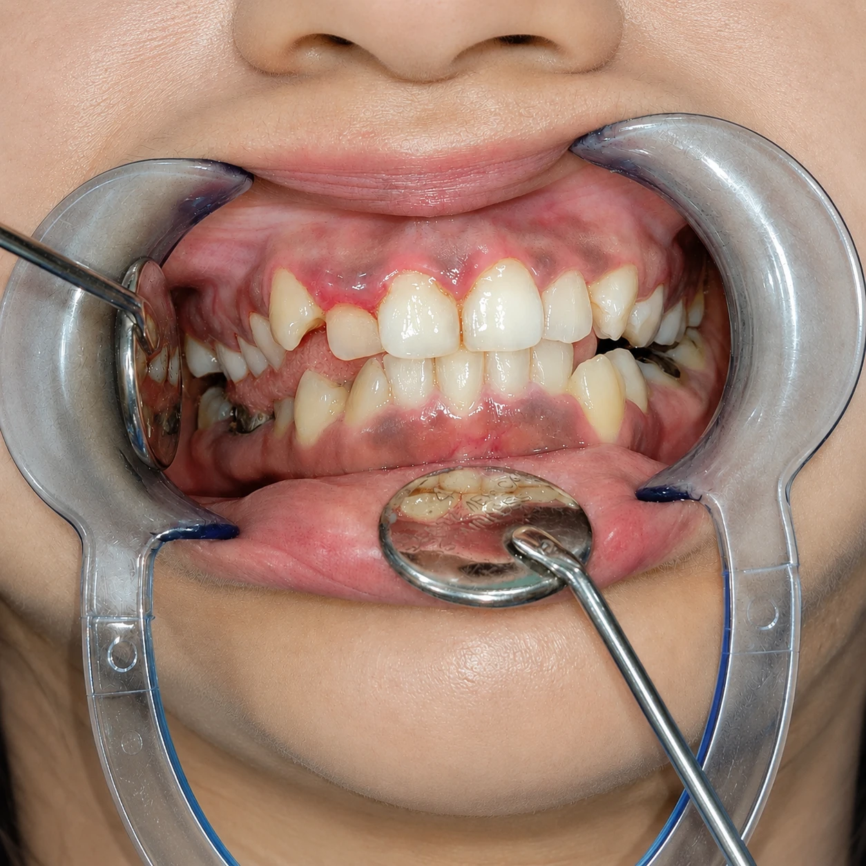 Dental Implant